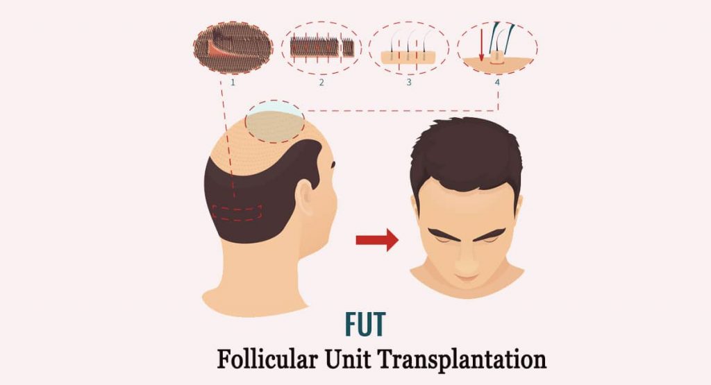 Hair Transplant